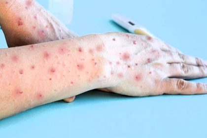 mpox
